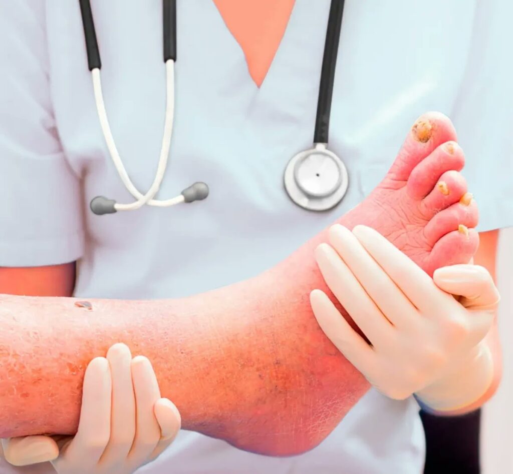 Especialista advierte alto riesgo de amputaciones y mortalidad por enfermedad arterial periférica en pacientes con diabetes