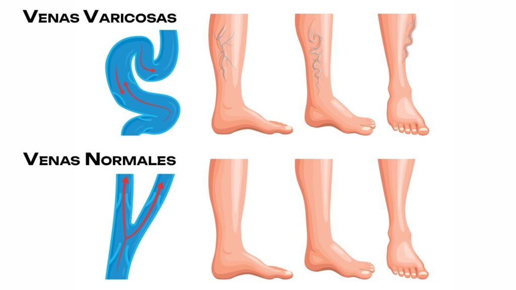 Crece preocupación por aumento de enfermedades venosas en RD.