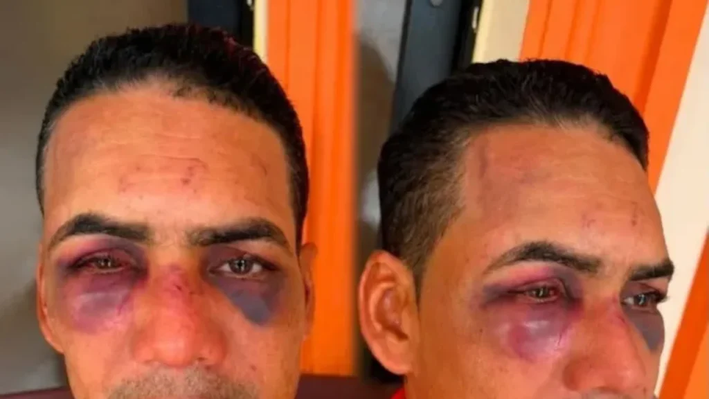 Hombre casi deja ciego a su pariente durante violenta disputa por una herencia en Azua