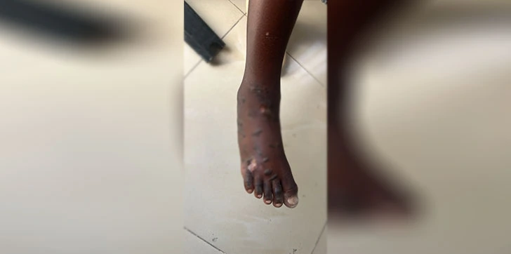 Mujer apresada tras presuntamente quemar con aceite caliente a su hijo de cinco años